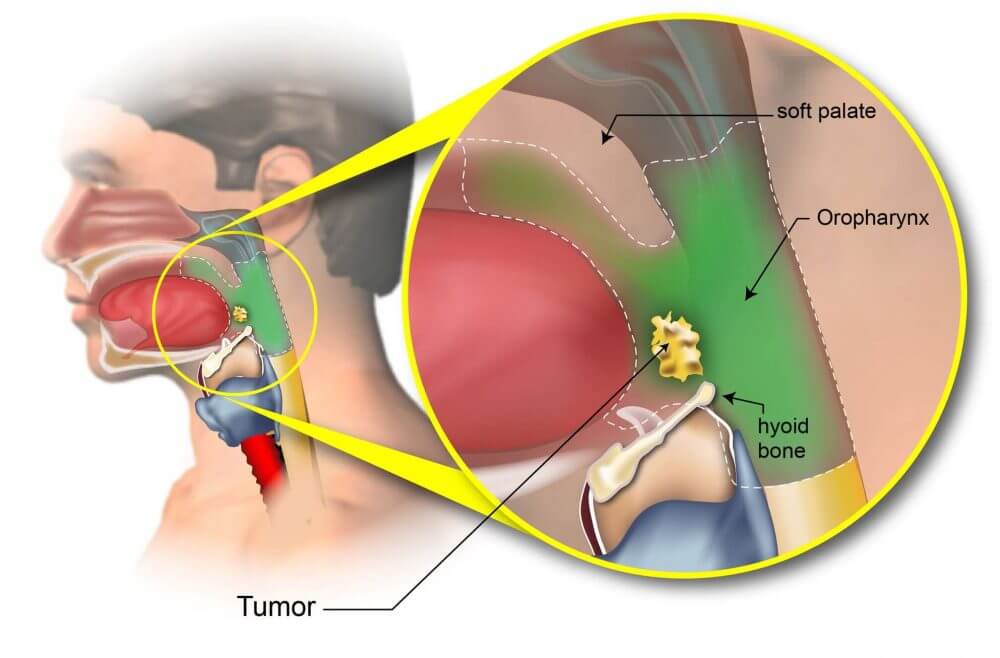 types-of-throat-cancer-symptoms-risk-factors-and-preventive-measures