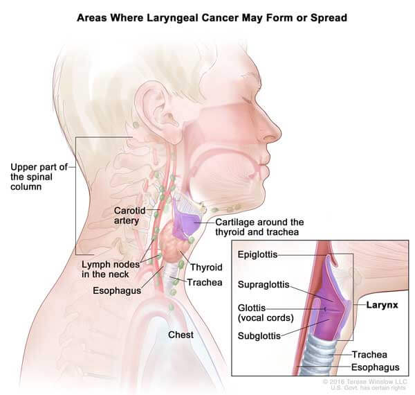 Types of throat cancer, symptoms. Risk factors and preventive measures, Labex Trade