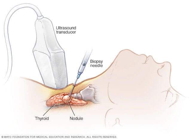 Laryngeal Cancer - Stages, symptoms, prognosis and treatment options, Labex Trade