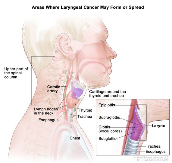 Laryngeal Cancer - Stages, symptoms, prognosis and treatment options, Labex Trade