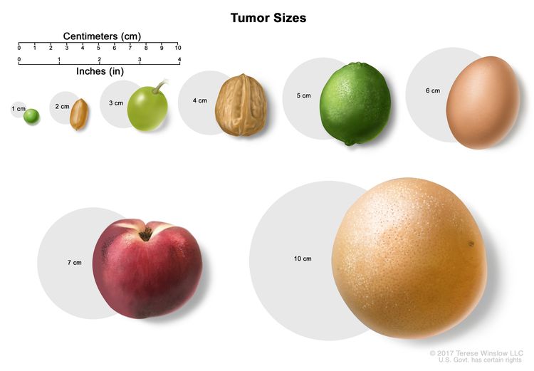 002-labextrade.com-tumor-sizes Laryngeal Cancer - Stages, symptoms, prognosis and treatment options, Labex Trade