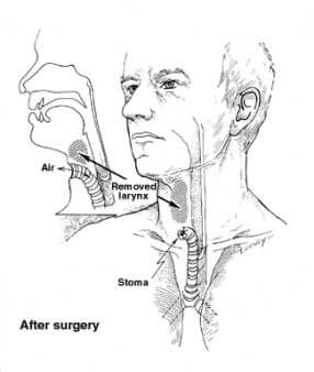 Hypopharyngeal Cancer - Stages, symptoms and prognosis. Treatment options, Labex Trade