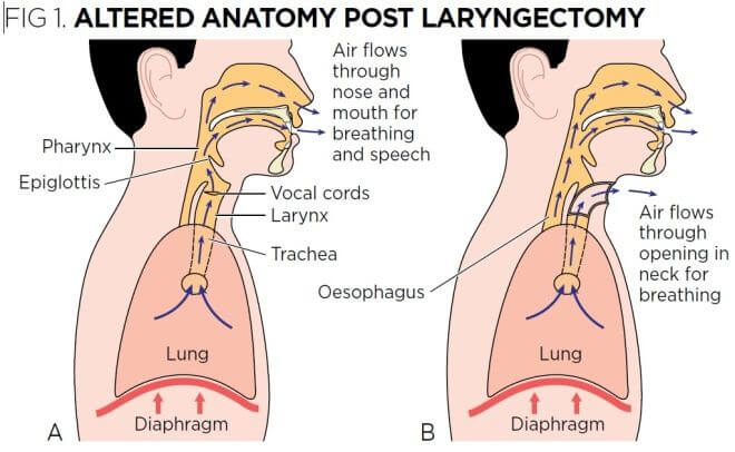 006-labextrade.com-Effect of laryngectomy