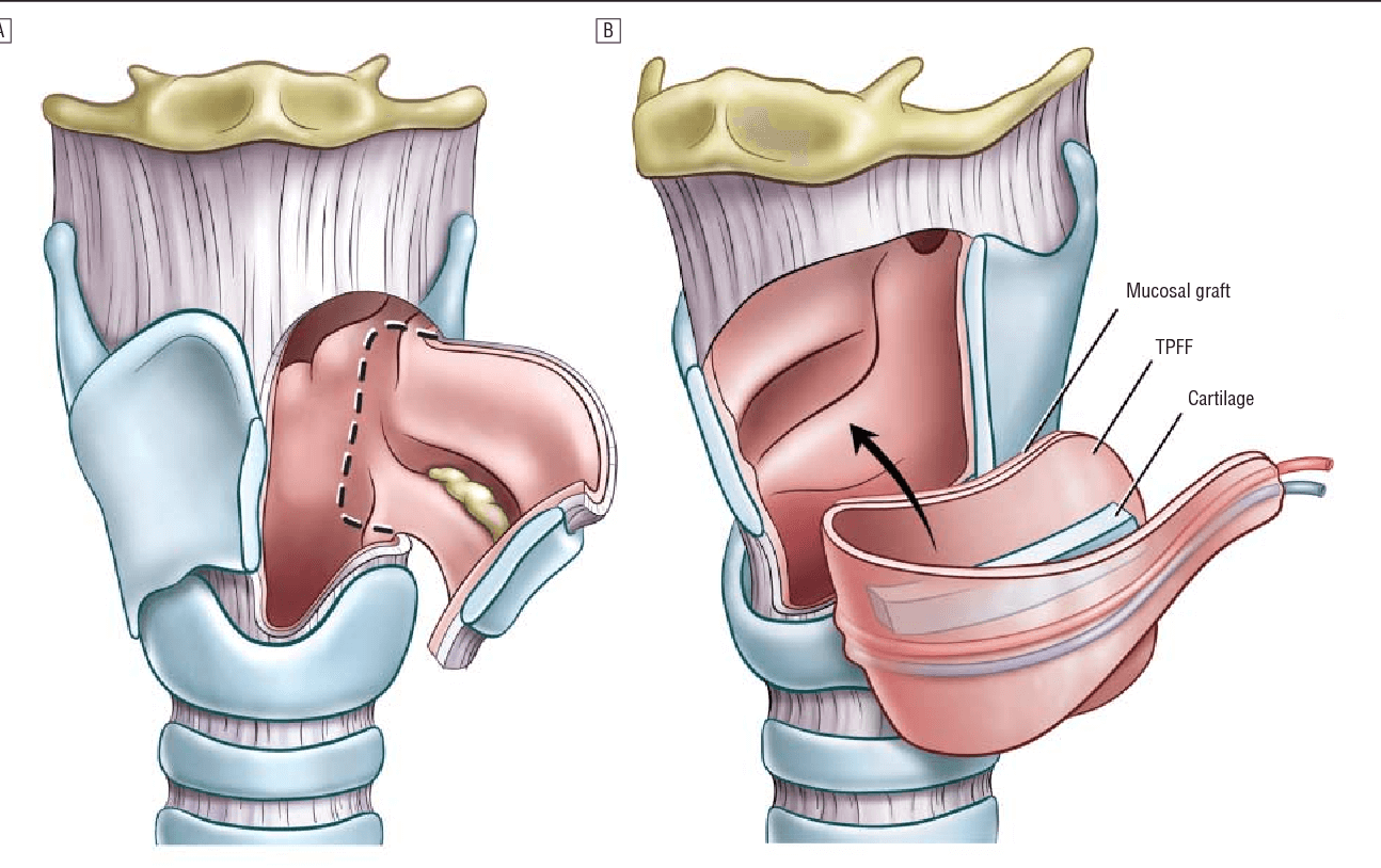 006-labextrade.com-Partial laryngectomy (1) 006-labextrade.com-Partial laryngectomy