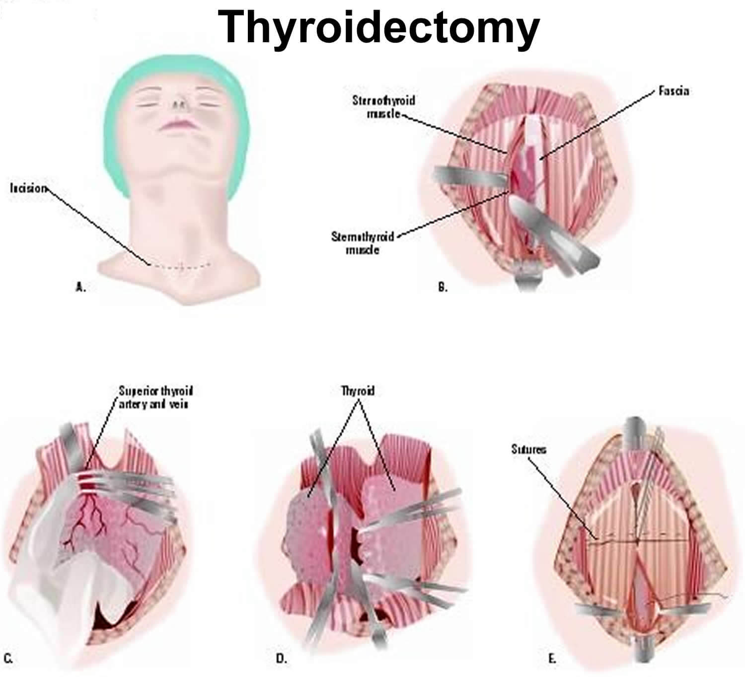 006-labextrade.com-Thyroidectom (1) 006-labextrade.com-Thyroidectom