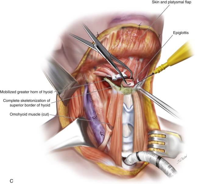 What To Expect During Laryngectomy Surgery, Total laryngectomy, Labex Trade