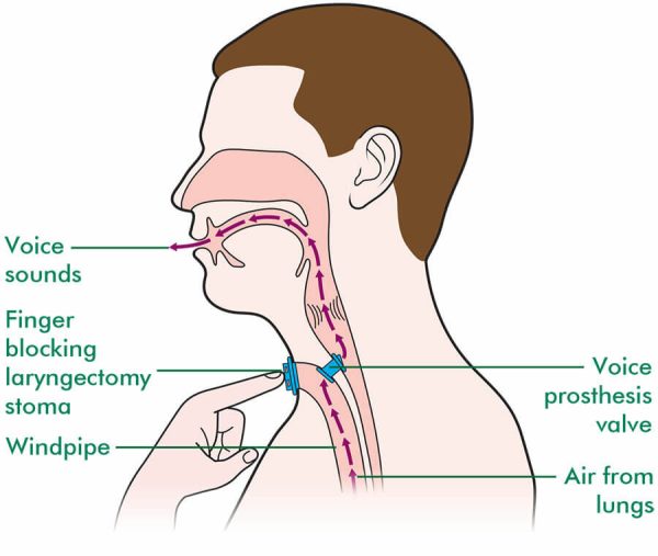 Cleaning the stoma area: Procedure and Equipment needed - Labex