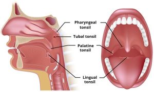 lingual tonsil cancer symptoms