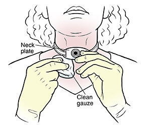 Cleaning the stoma area, Labex Trade