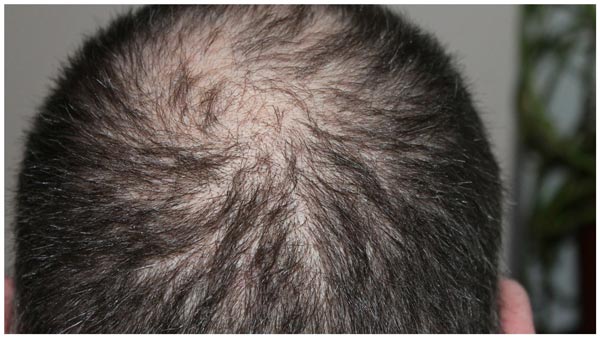 Laryngectomy - How To Handle Pain From Radiation Hair Loss